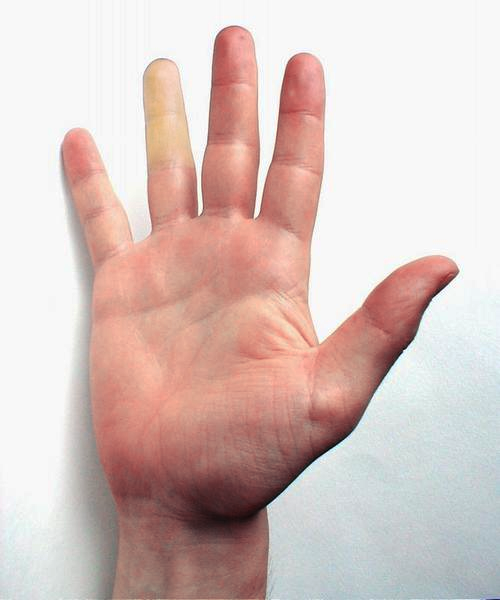 Ziekte van Raynaud - Witte vinger